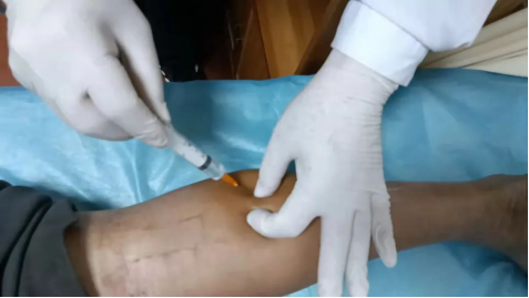 正清风痛宁注射液离子导入配合针刀治疗第3腰椎横突综合征的临床研究