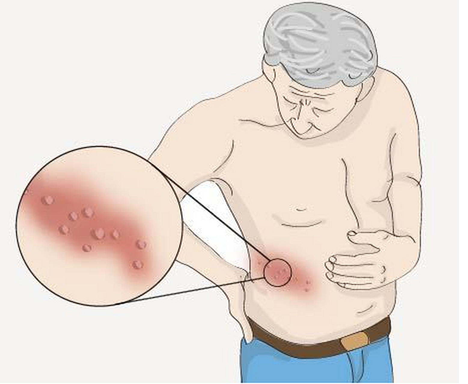 正清风痛宁注射液联合Vit B12注射液治疗带状疱疹的临床研究