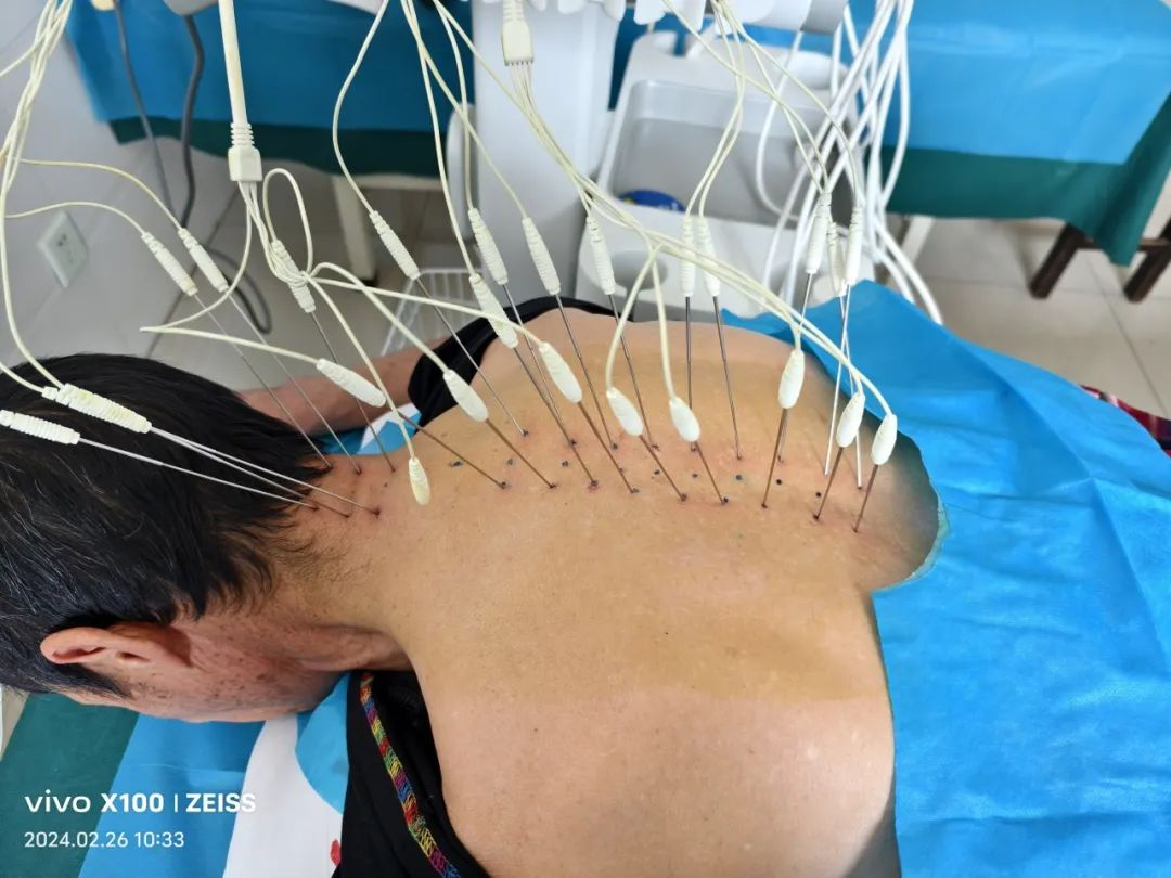 疼痛治疗技术之内热针疗法介绍