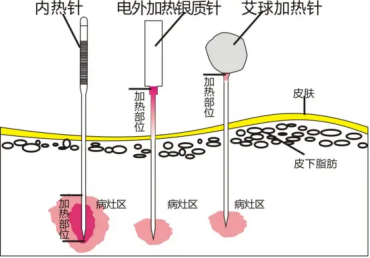 中医内科疼痛门诊特色治疗项目——内热针