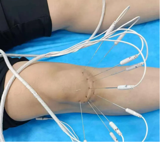 内热针治疗实例