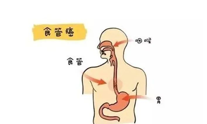 吞咽困难有梗噎感？注意警惕食管癌！