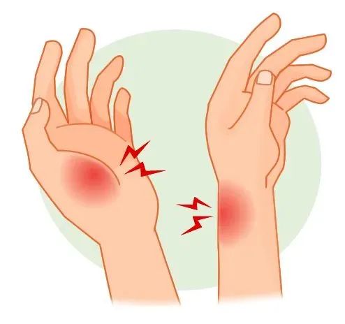 扳机指——腱鞘炎的防治