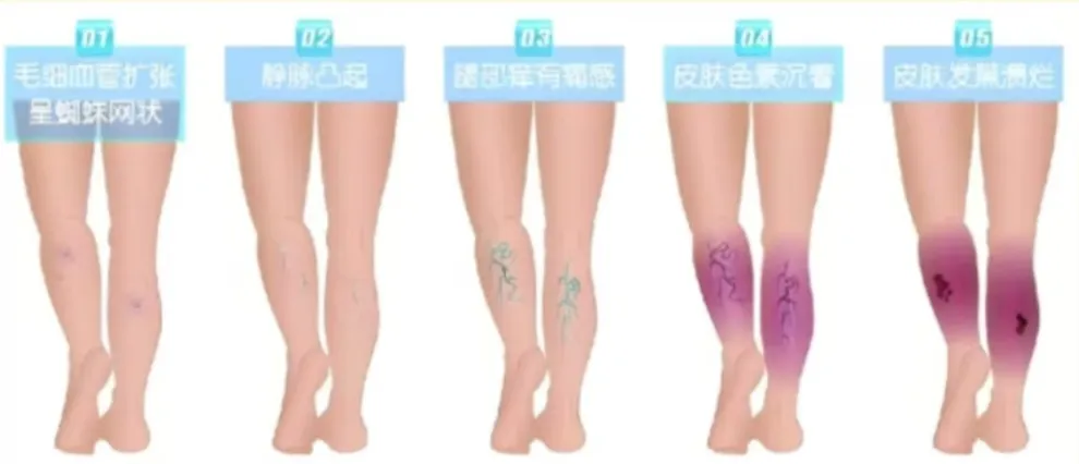 健康知识科普：谨防“老烂腿”