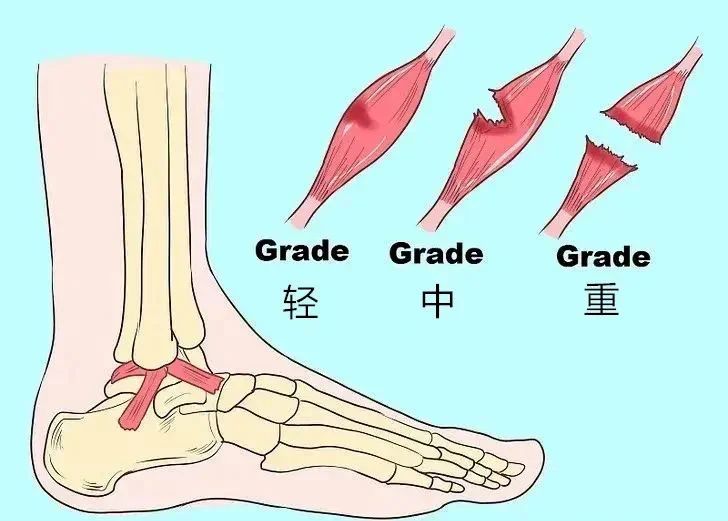 踝关节扭伤后该怎么处理？别急！马上告诉你
