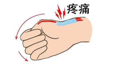 腱鞘炎您不知道的那些事