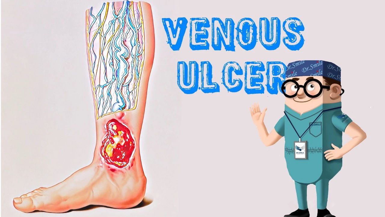 关于老烂腿，你需要知道的事