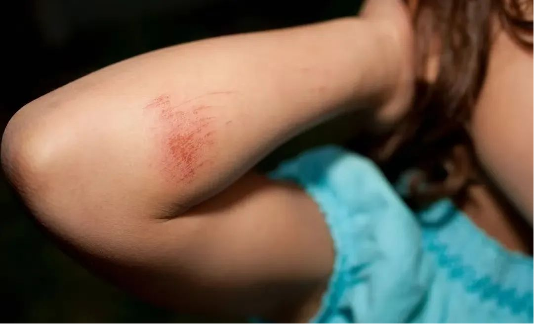 擦伤后处理方法你做对了吗？