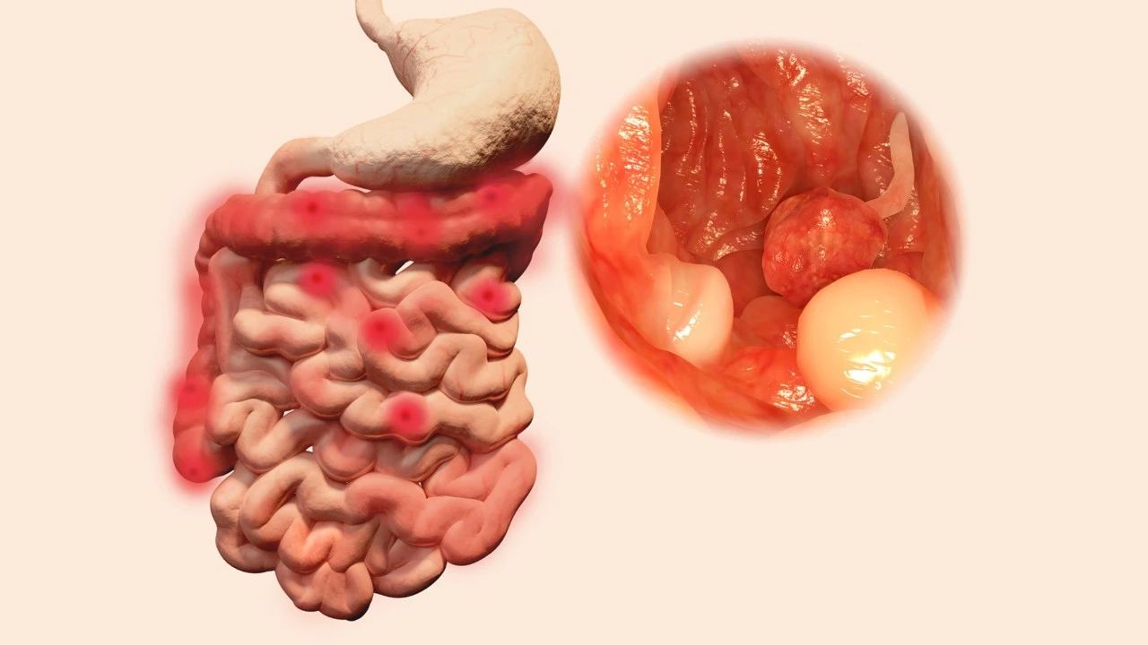 肠道里长了息肉，上厕所时会有5个提示，别等肠癌了才反应过来